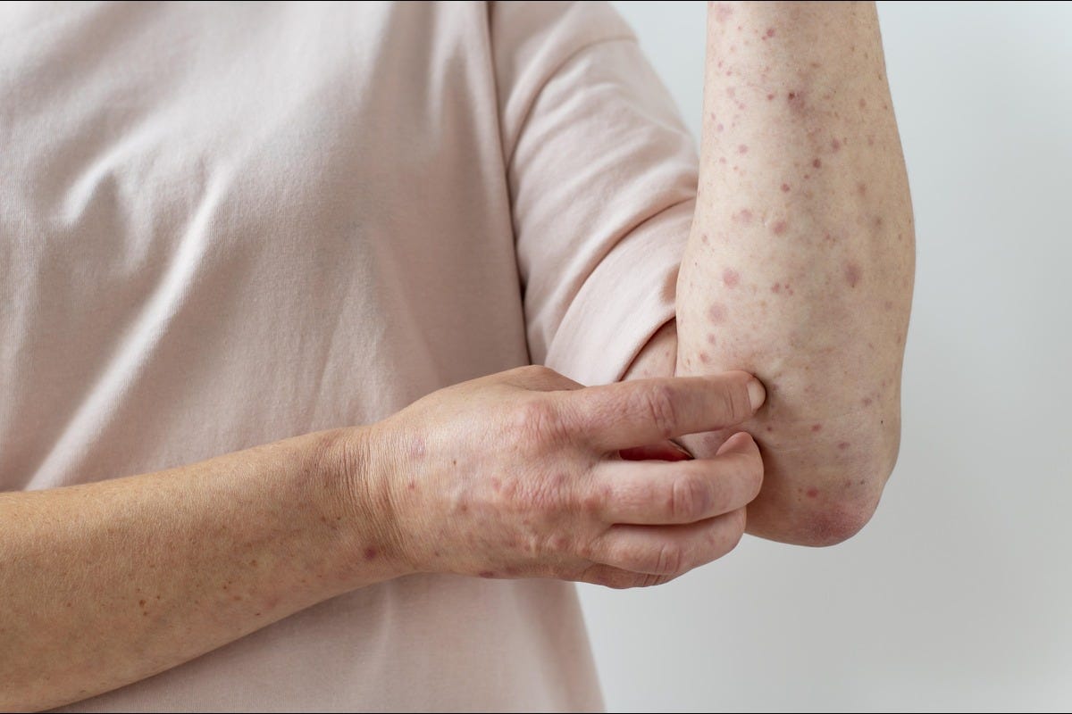 Measles: Symptoms, Treatment & Prevention