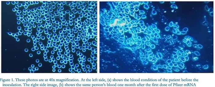 blood condition of the patient before inoculation blood condition of the patient before inoculation