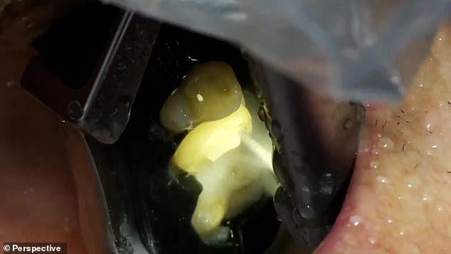 Perspective says that its robot is able to drill to an accuracy of just 100 microns - roughly the thickness of a human hair Perspective says that its robot is able to drill to an accuracy of just 100 microns - roughly the thickness of a human hair